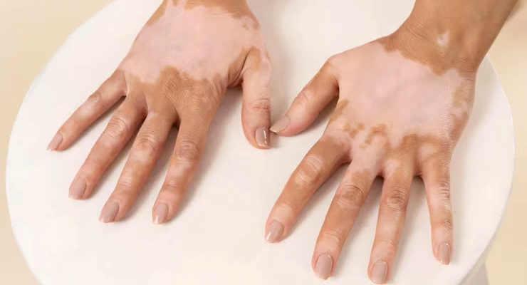 Vitiligo Surgery Treatment in Bangalore